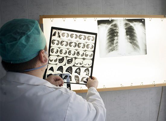 Tuberculosis